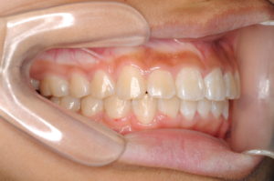 つくば・土浦の矯正歯科　つるみ矯正歯科　歯並び矯正症例C　上顎前突（出っ歯）